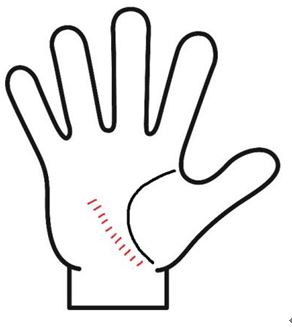 ・健康線が梯子状