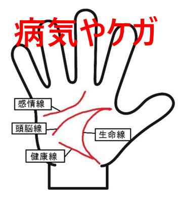 病気やけがの手相