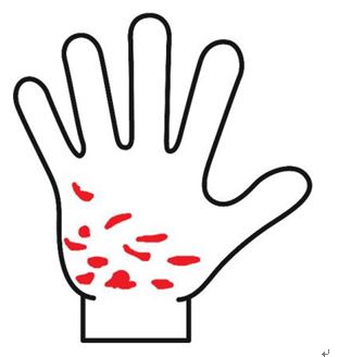 手のひらの色が赤と白のまだら